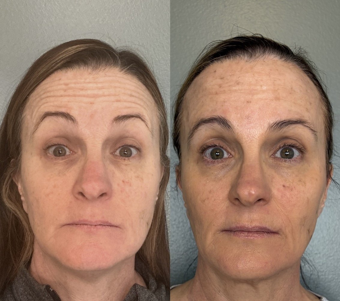 Dysport forehead lines