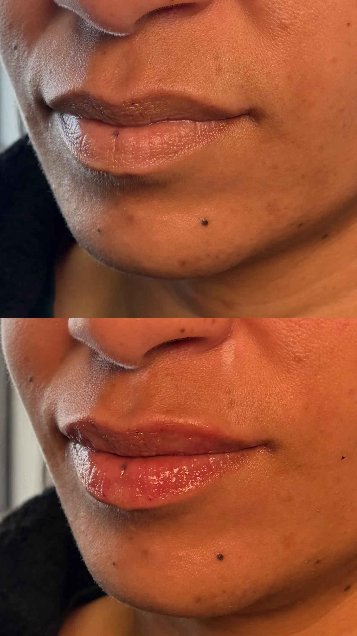 Lip filler (half syringe)
