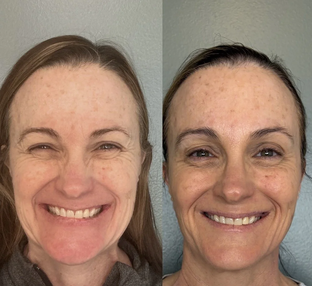 Dysport smile lines, lip flip