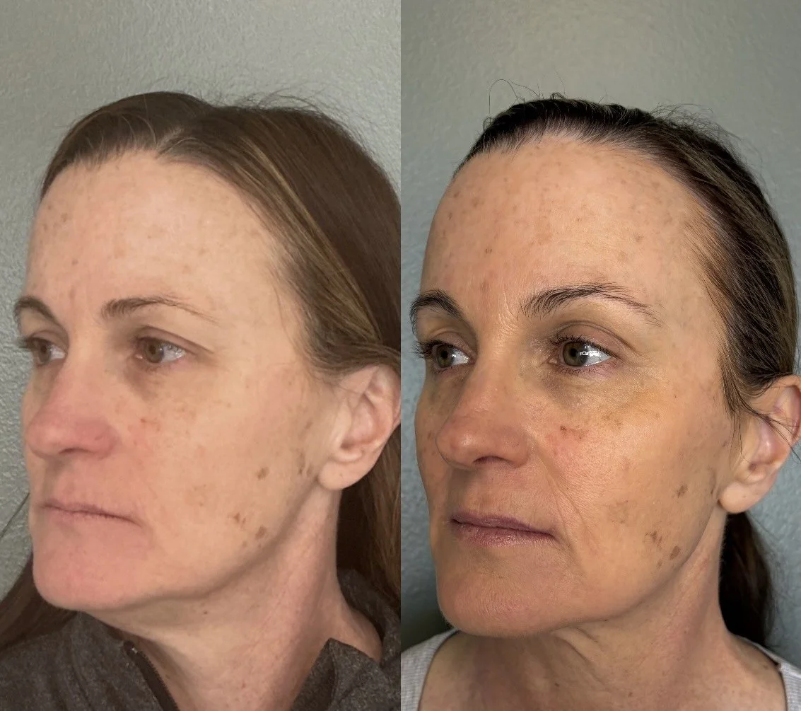 Dysport jawline/Nefertiti Lift