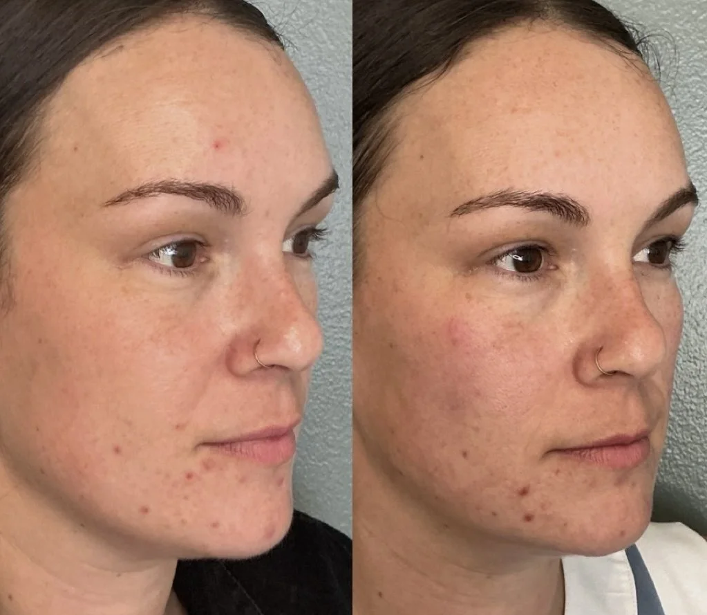 Cheek Filler
