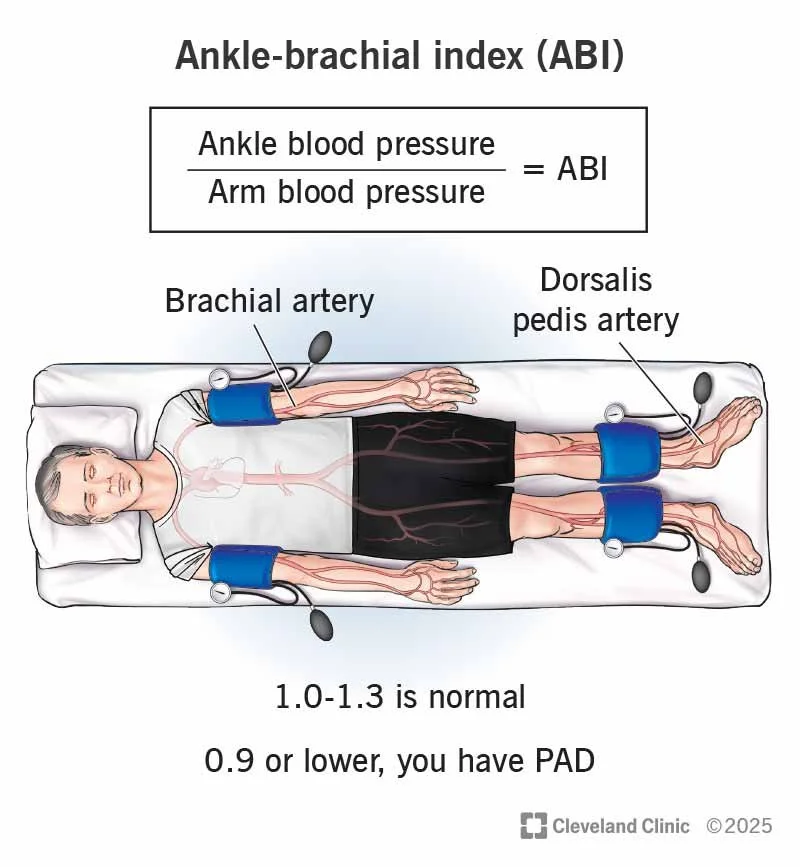 Diagram of an elderly person lying in a hospital bed with blood pressure cuffs on their arms and legs. Labels point to the brachial artery and dorsalis pedis artery, illustrating how to calculate the ankle-brachial index (ABI). The image includes a formula for ABI and explains normal and low values indicating peripheral artery disease, with a note from Cleveland Clinic.