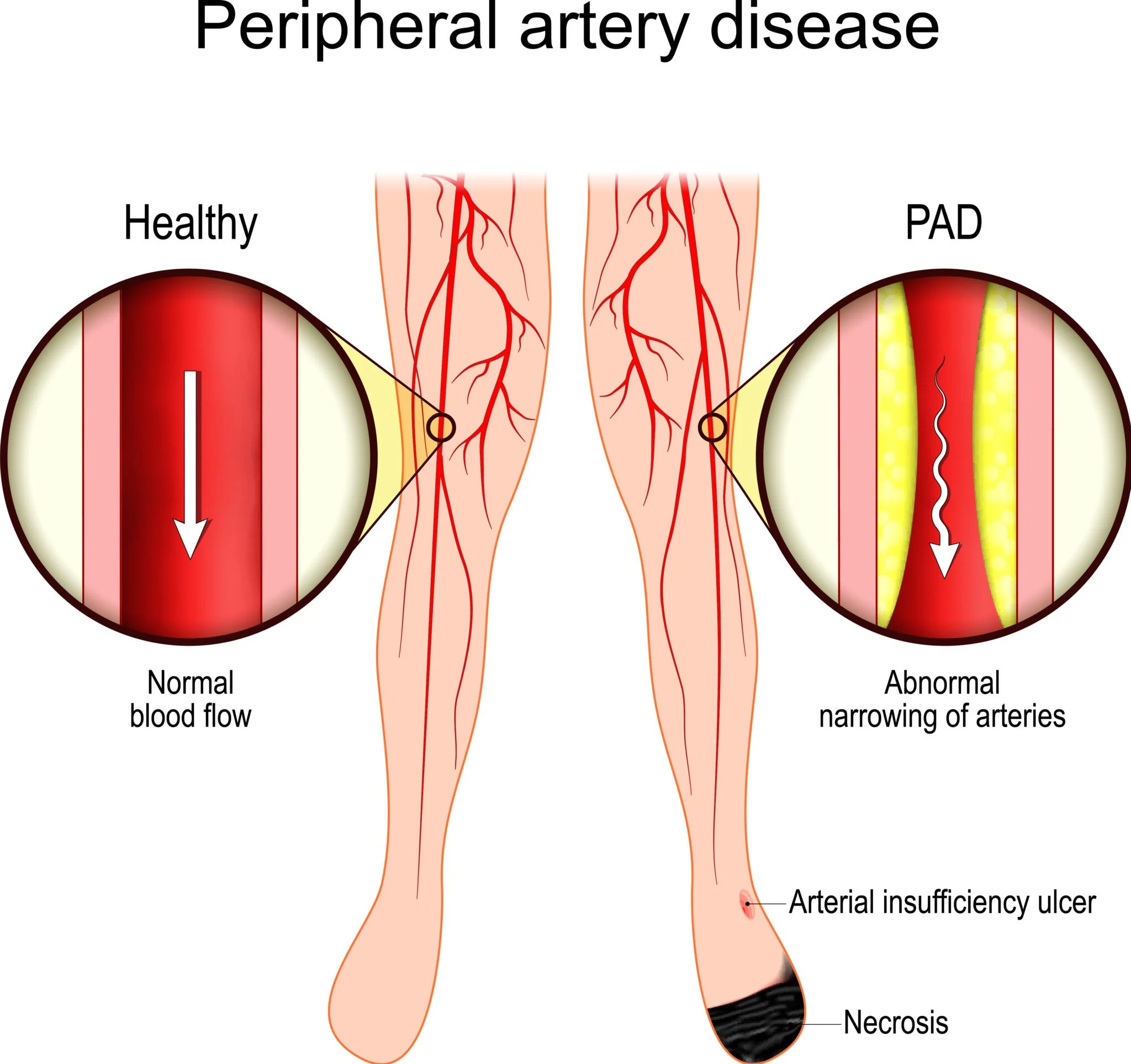 Diagram comparing healthy and abnormal arteries affected by peripheral artery disease. The healthy artery shows normal blood flow, while the abnormal artery demonstrates narrowing and blockage, indicating arterial insufficiency, ulcer, and necrosis.