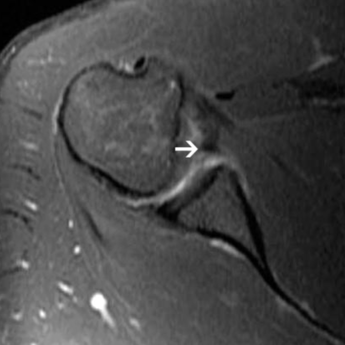 Axial MRI scan demonstrating an anterior labrum tear