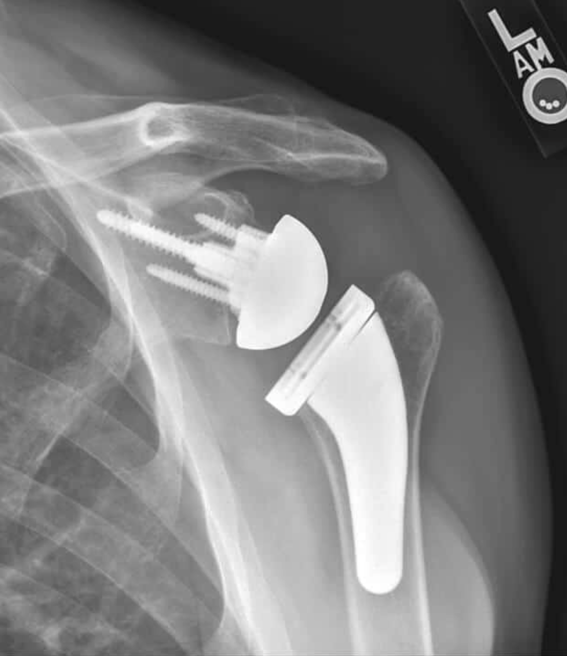 X-ray image of a shoulder with a reverse shoulder prosthesis