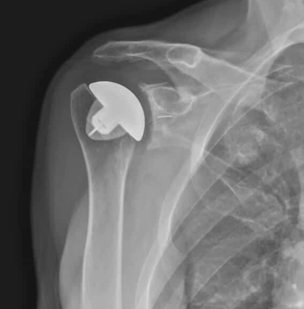 X-ray of a shoulder joint showing an anatomic total shoulder arthroplasty