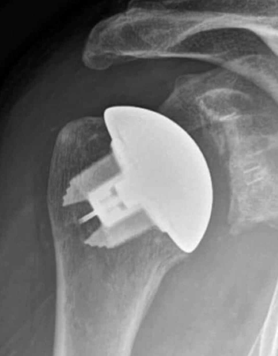 X-ray image of a shoulder with an anatomic total shoulder arthroplasty