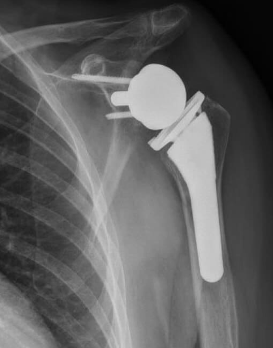 X-ray image showing a shoulder with a reverse total shoulder arthroplasty