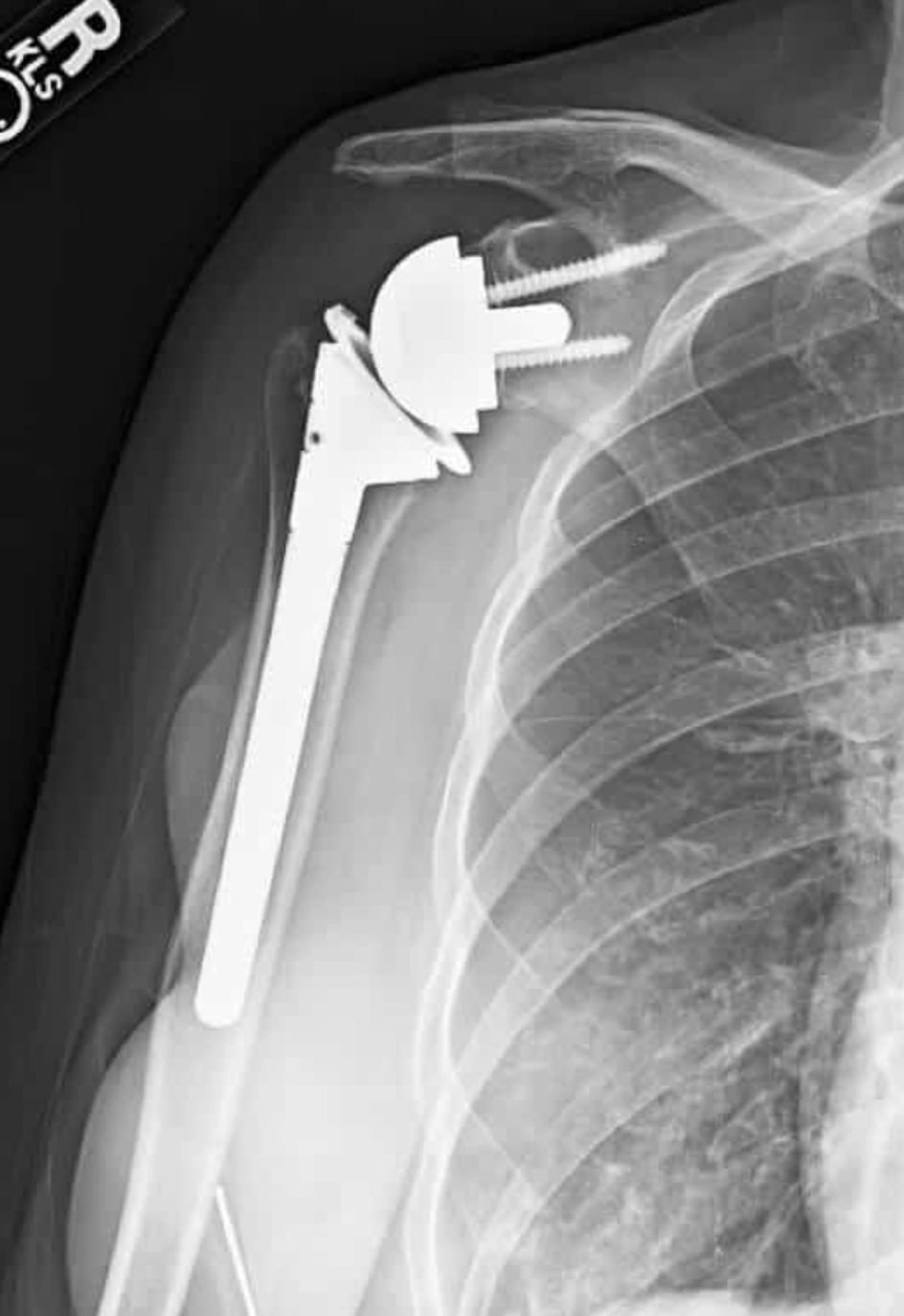 X-ray image of a right shoulder with reverse shoulder arthroplasty