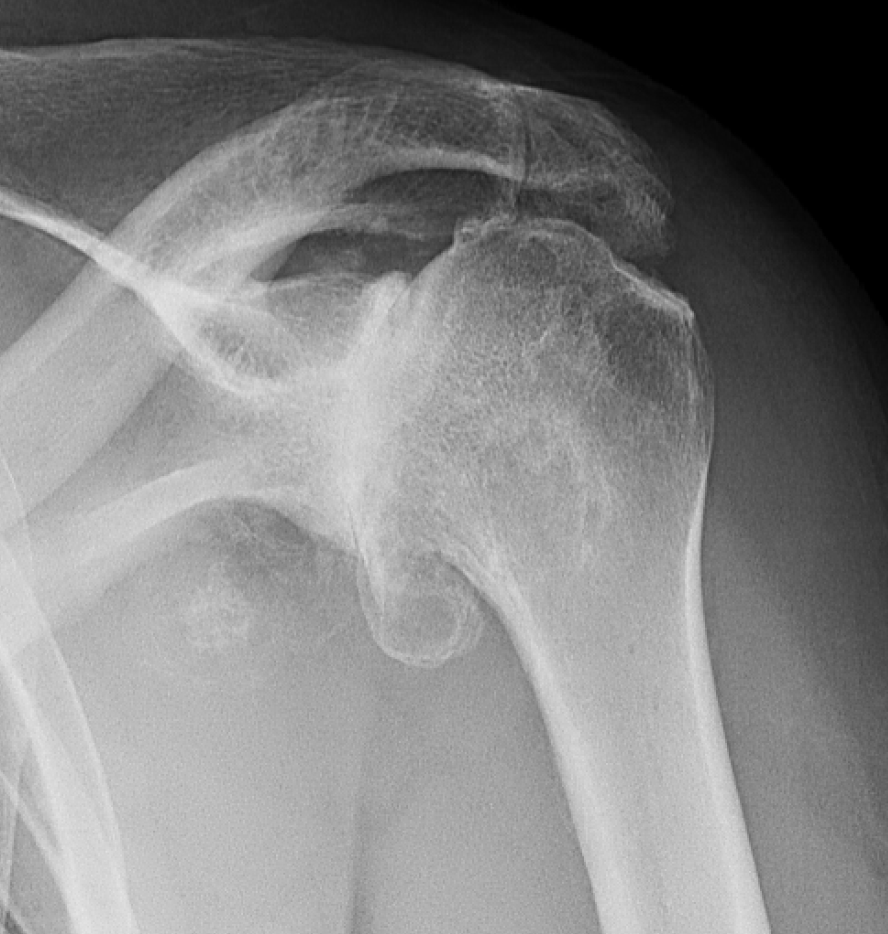 X-ray image of a shoulder showing severe degenerative joint diseases