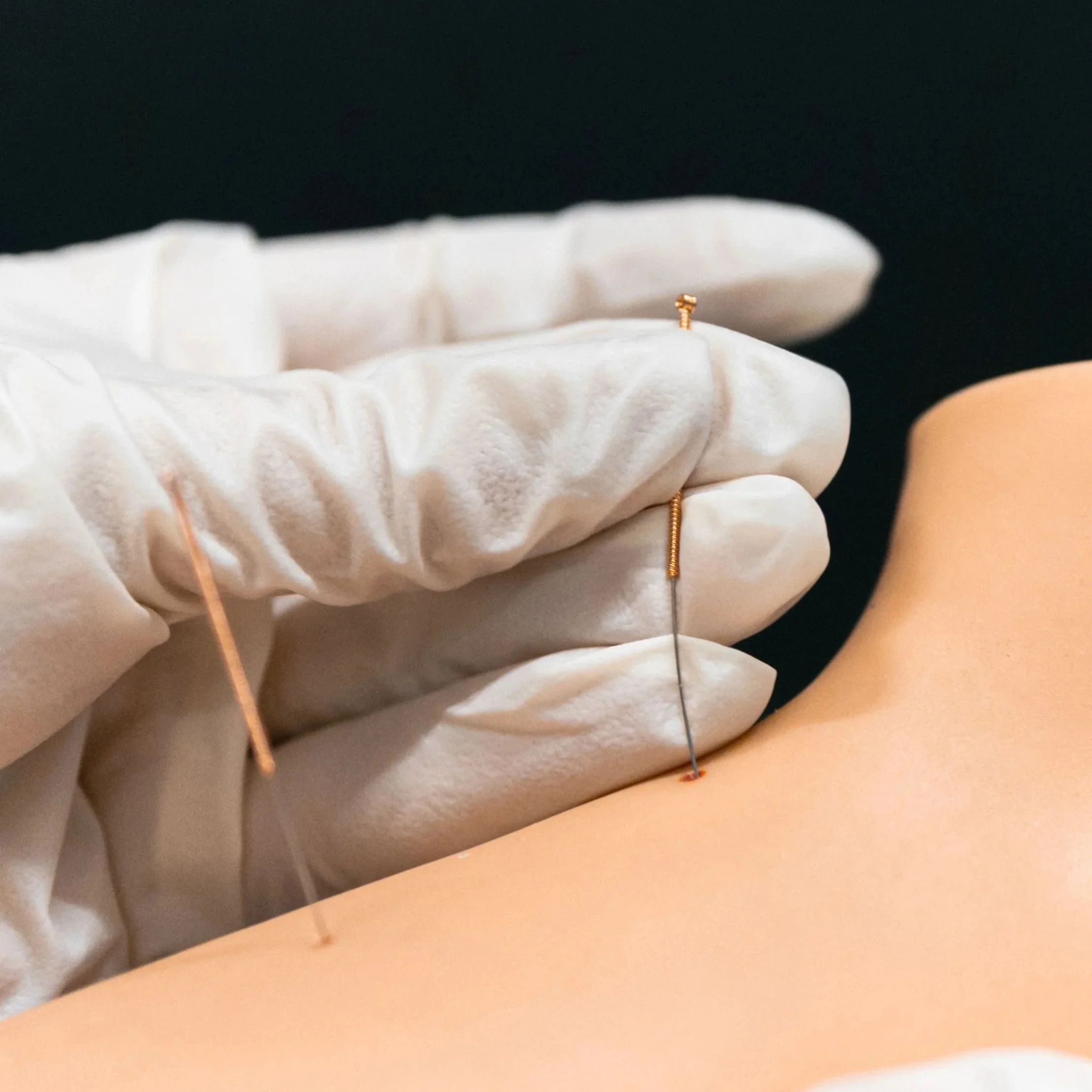 Soft Tissue Immediate Release: How Dry Needling Resets Muscle Tension