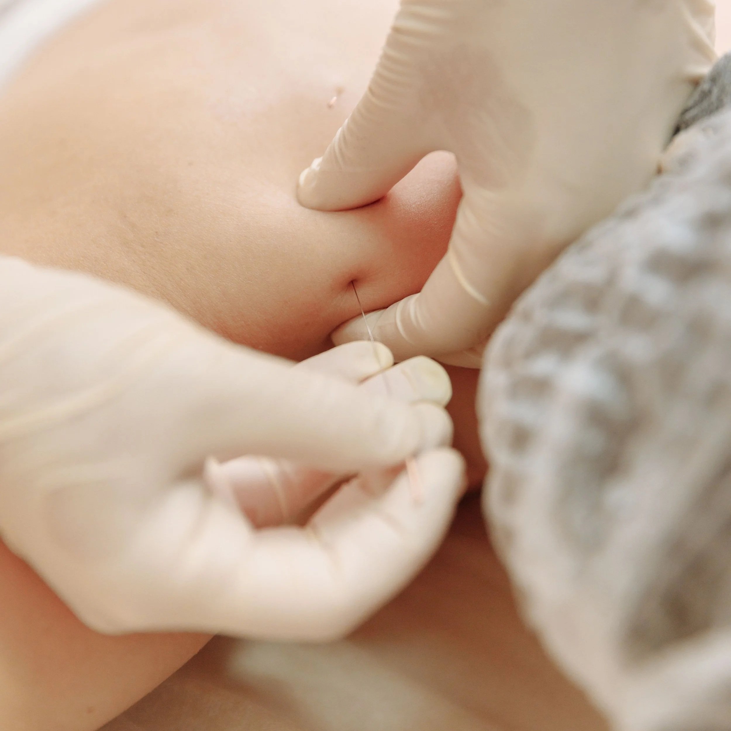 Accelerating Tendon Healing: Why Dry Needling Succeeds Where Traditional PT Stalls