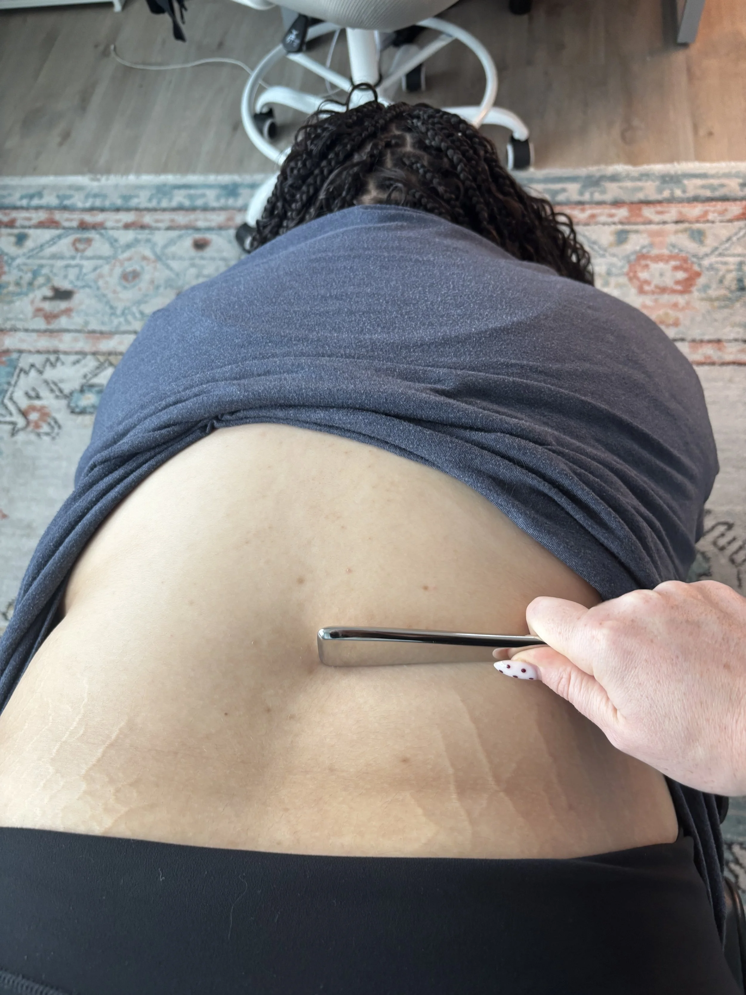 A person receiving an acupuncture treatment with a needle inserted into their lower abdomen, while lying on a bed or examination table.