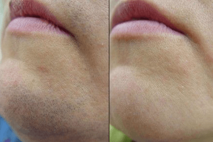 Side-by-side comparison of skin showing reduction in acne or blemishes.