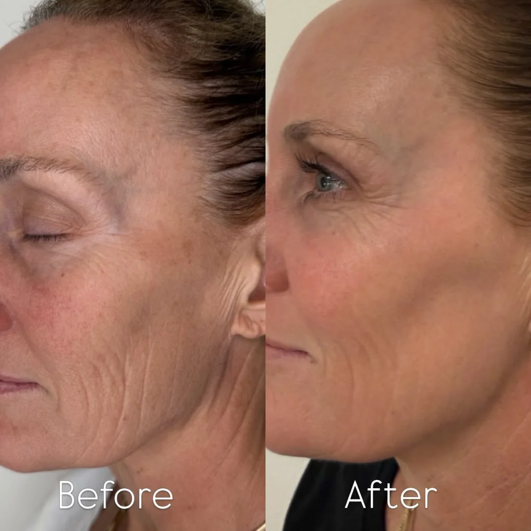 Results after 2 sessions of BBL + MOXI
I&rsquo;m obsessed!

✨skin is smoother
✨color is even
✨texture is softer

Comment 🙌 if you agree these results are 💯

Skinwise Newport Beach
180 Newport Center Drive, Suite 265
Newport Beach, CA 92660

Call/ T
