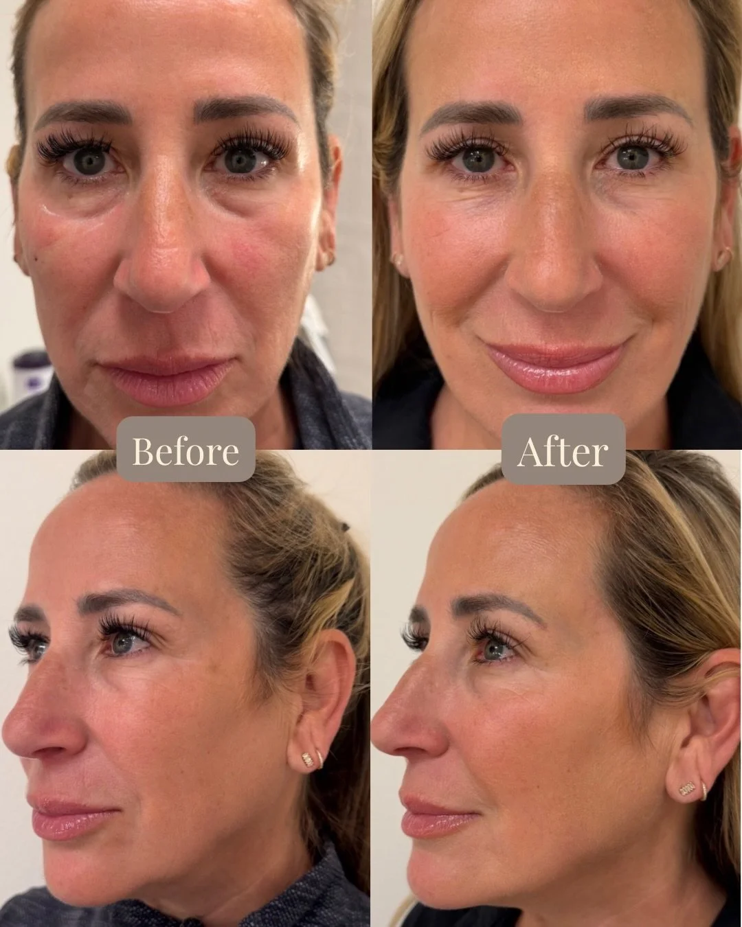 Natural facial balancing designed to enhance &mdash; never overpower. ✨

Beautiful results by @aesthetics.by.camille 🤍

Using 3 syringes of filler placed throughout the cheeks, jawline, and chin. 
We restored youthful structure, softened signs of vo