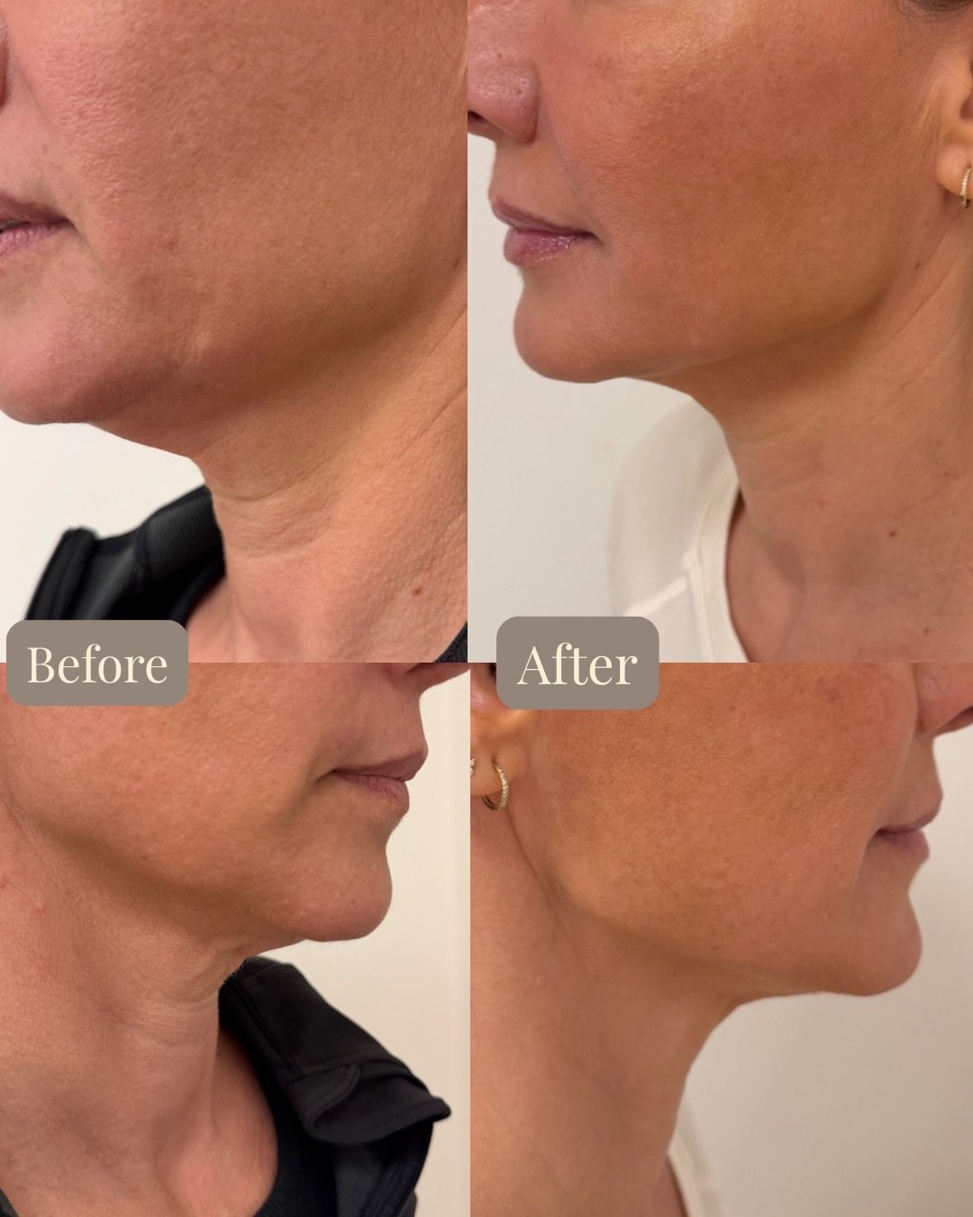 &ldquo;Subtle enhancements&rdquo; doesn&rsquo;t always mean subtle results ✨

This transformation is the result of a customized, multi-treatment approach designed to restore structure, tighten skin, and create natural definition throughout the lower 