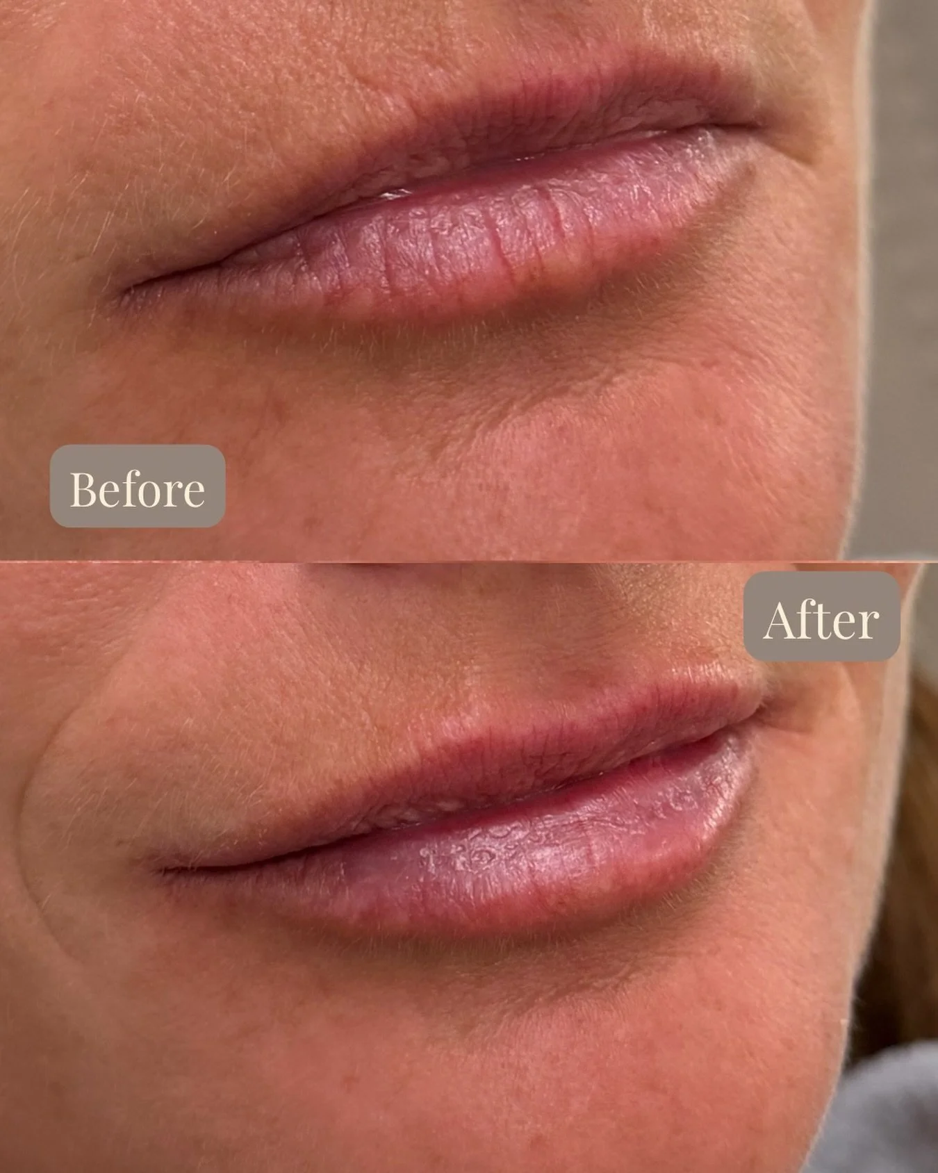 My new obsession?&hellip;
Naturally filled lips 🤍✨ 💋

SkinWise Newport Beach
714.318.5199

#jennifermollerpac #skinwisenewportbeach #lipfiller