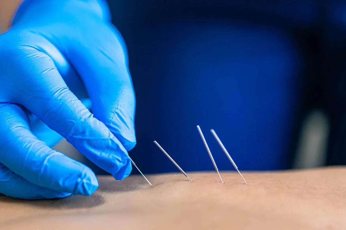 A medical professional wearing blue gloves inserts acupuncture needles into a patient's skin.