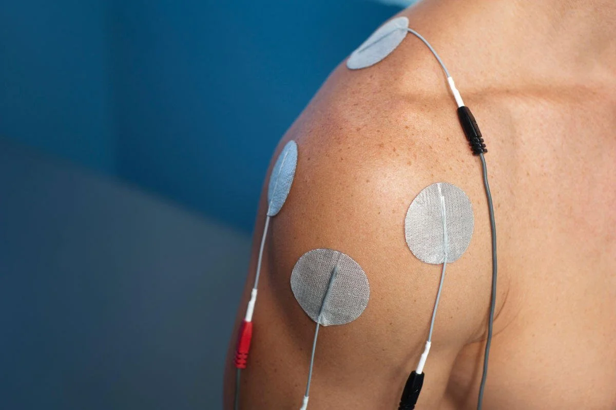 Close-up of a person's upper arm with several electrode patches attached, connected to wires for medical testing or treatment.