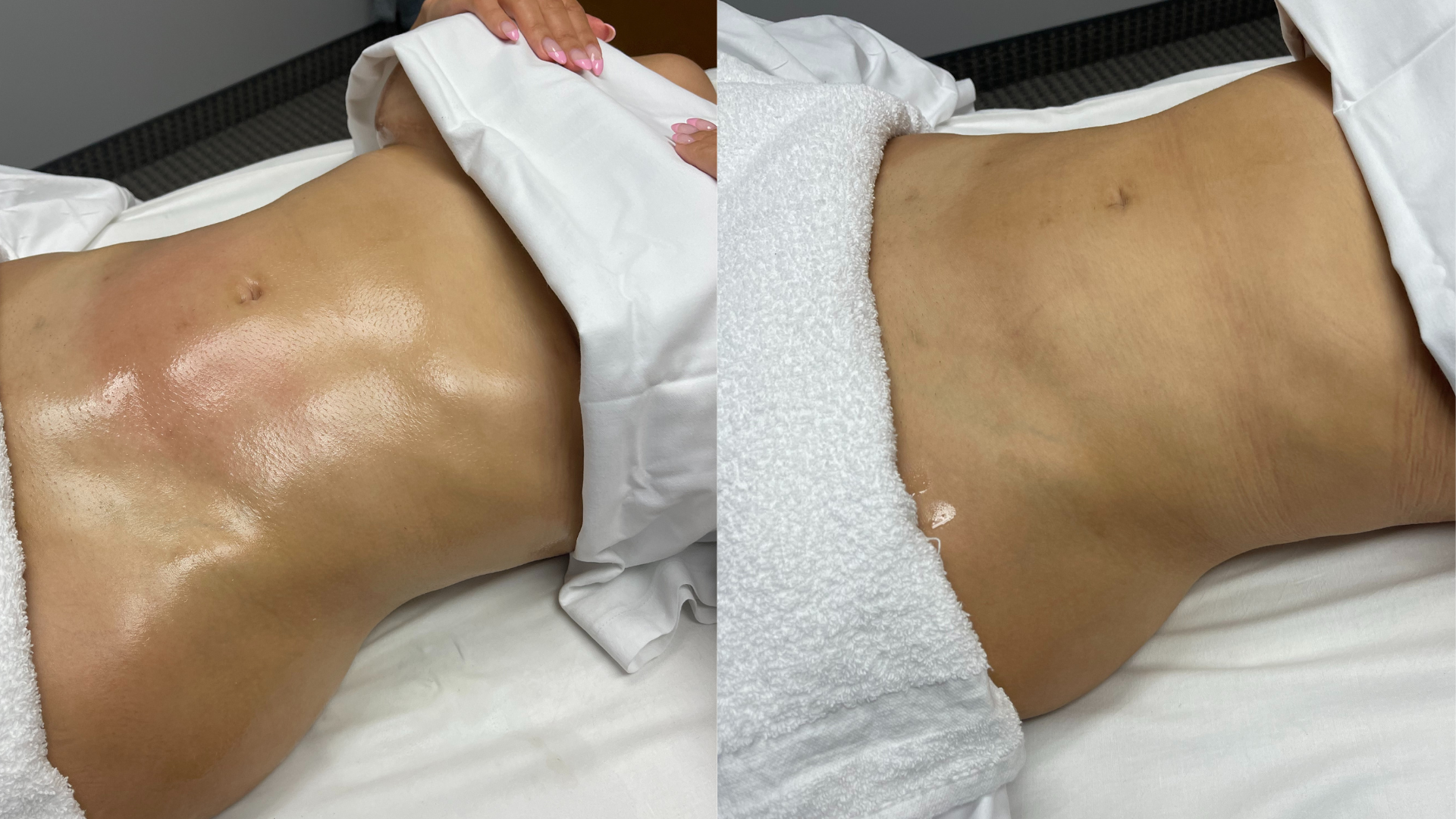 Manual Lymphatic Drainage Transformation