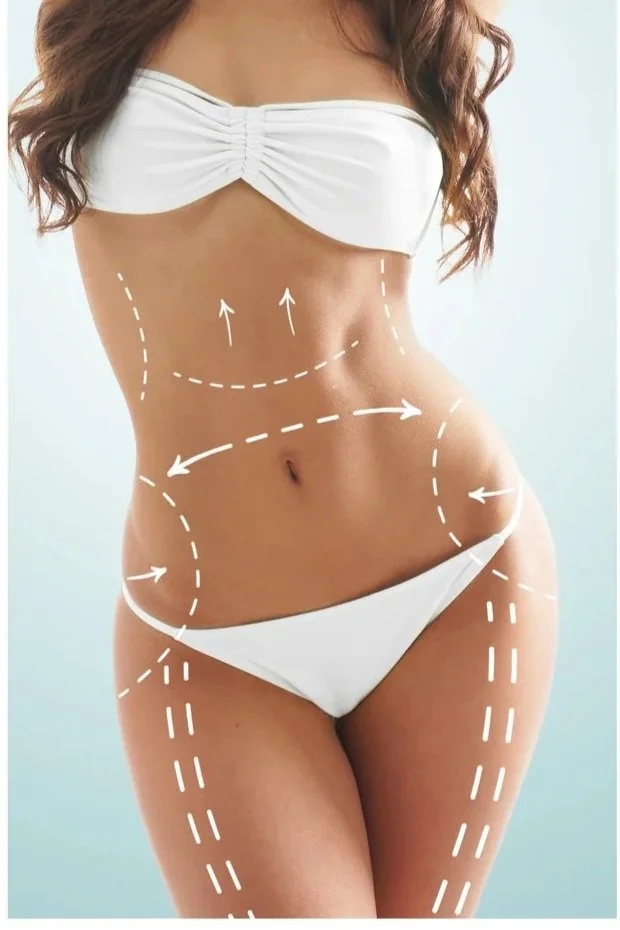 A woman's midsection with white dashed lines and arrows indicating areas for cosmetic or surgical body contouring, wearing white underwear and a white strapless top.