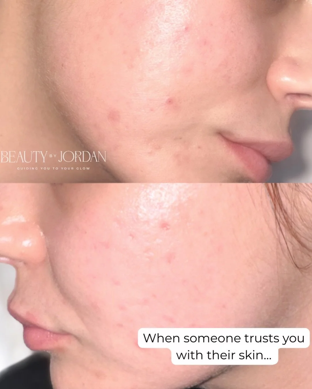 Being trusted with someone&rsquo;s skin is something I never take lightly.

Healing takes time, support, and consistency and I&rsquo;m honored to walk that journey with my clients. 💫she has come a long way with her skin and I&rsquo;m so so proud of 