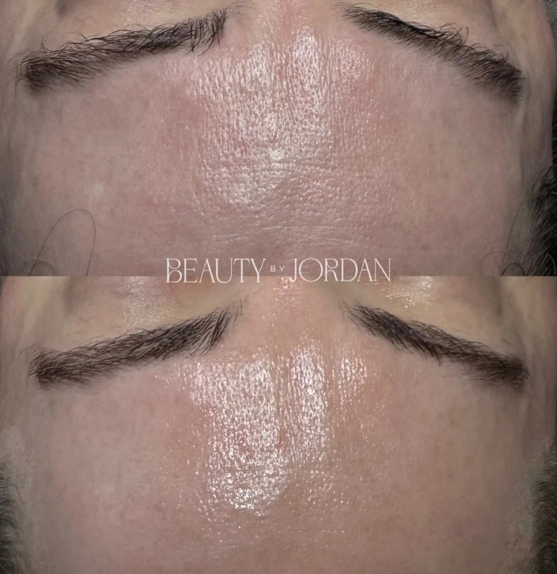 These photos were taken just 20 minutes apart.

If you look at the right side of her face&mdash;especially near the brow&mdash;you can see the skin sitting slightly lower in the &ldquo;before,&rdquo; subtly pulling the brow down with it. This is some