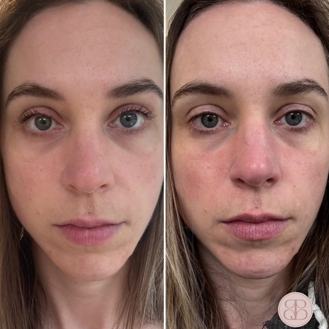 Virtual Client Skin Progress 💫

Just over 3 months in, and the difference is already amazing. 

What you&rsquo;re seeing isn&rsquo;t one miracle product. It&rsquo;s the result of a personalized plan, small adjustments over time, and someone who comm