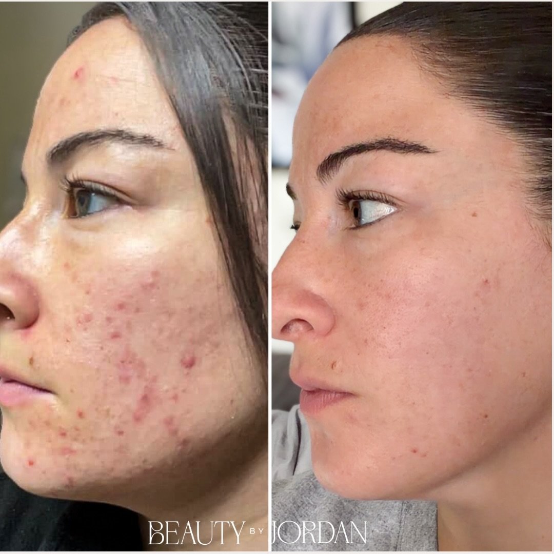 Virtual Client 🫶🏻

I am SO proud of her.

I went to college with Alex, and she actually first came to me for help with her skin back in 2019. She purged quite a bit in the beginning, and if you&rsquo;ve ever dealt with acne, you know how hard it ca