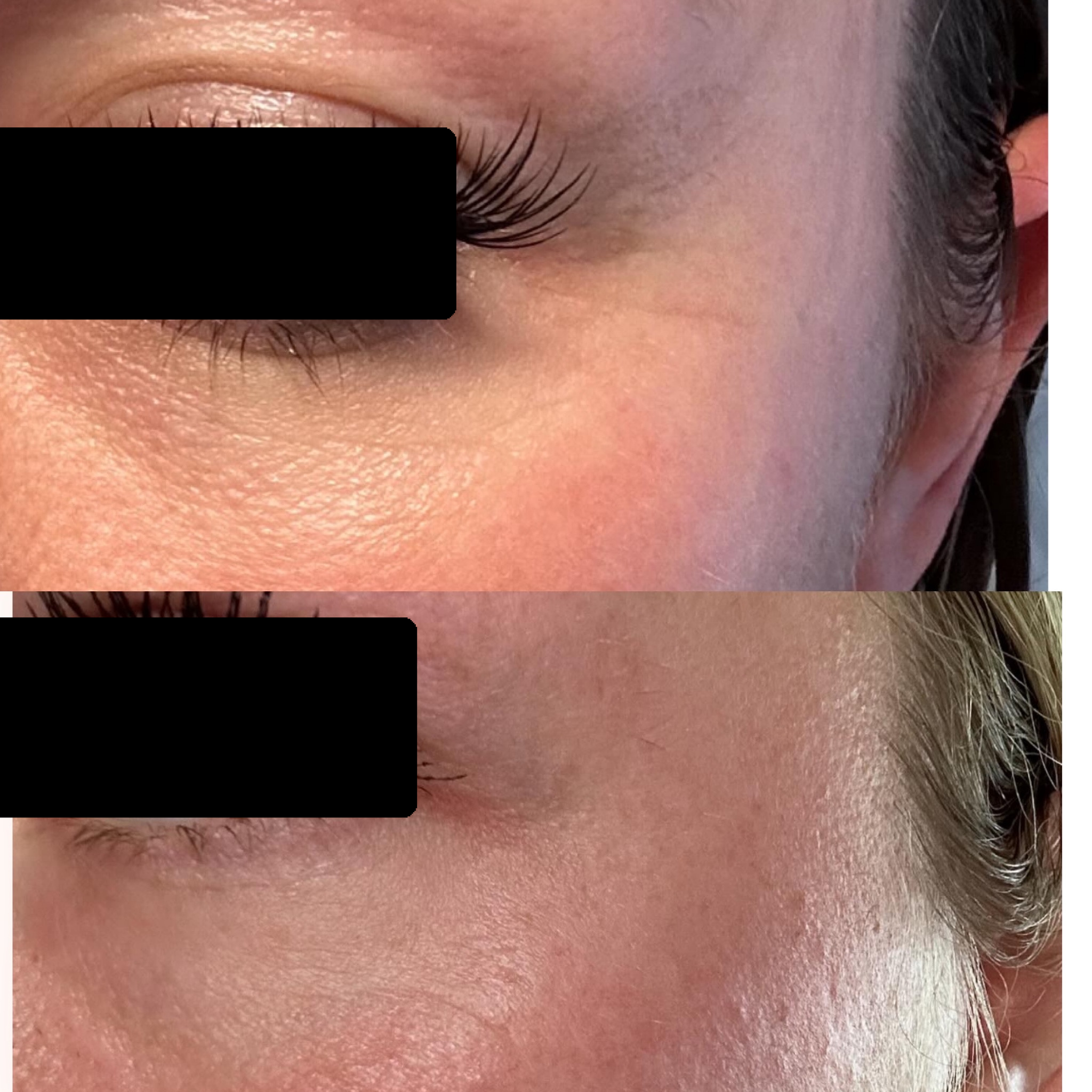 emergency eye lift.png