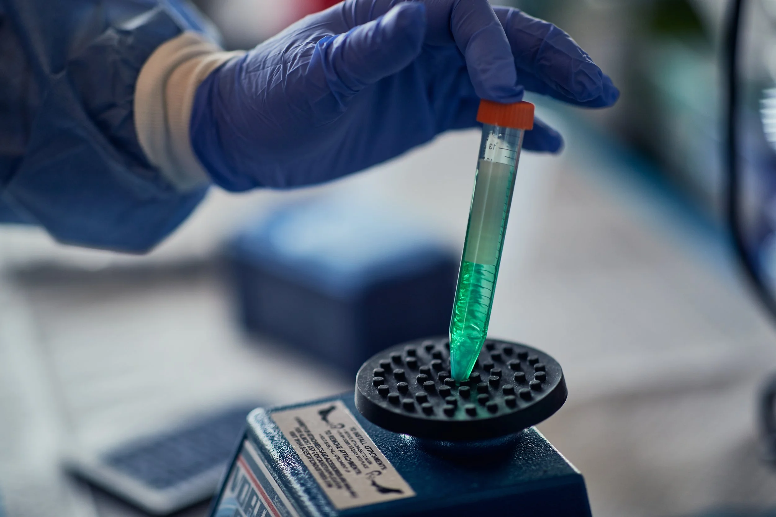 New Lab Test Identifies Lupus Flare Risk 12 Weeks in Advance