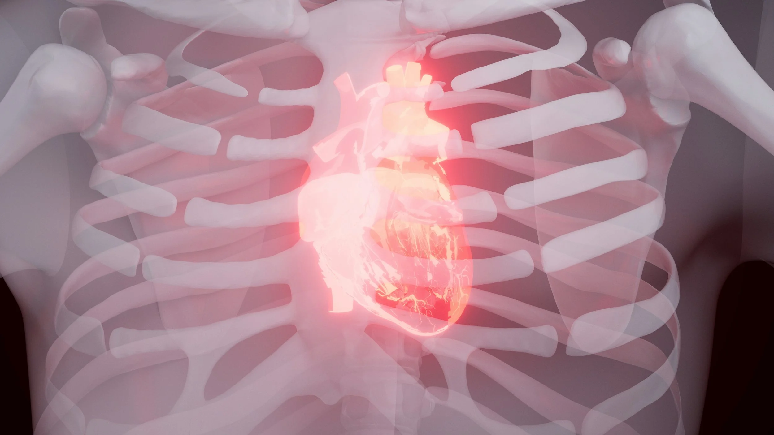 Atrial Fibrillation, Hydroxychloroquine, and Lupus