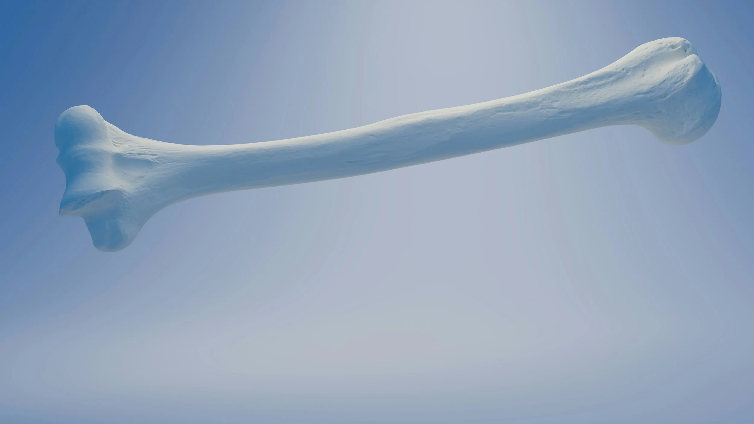 Osteoporosis, Bone Health, & Lupus