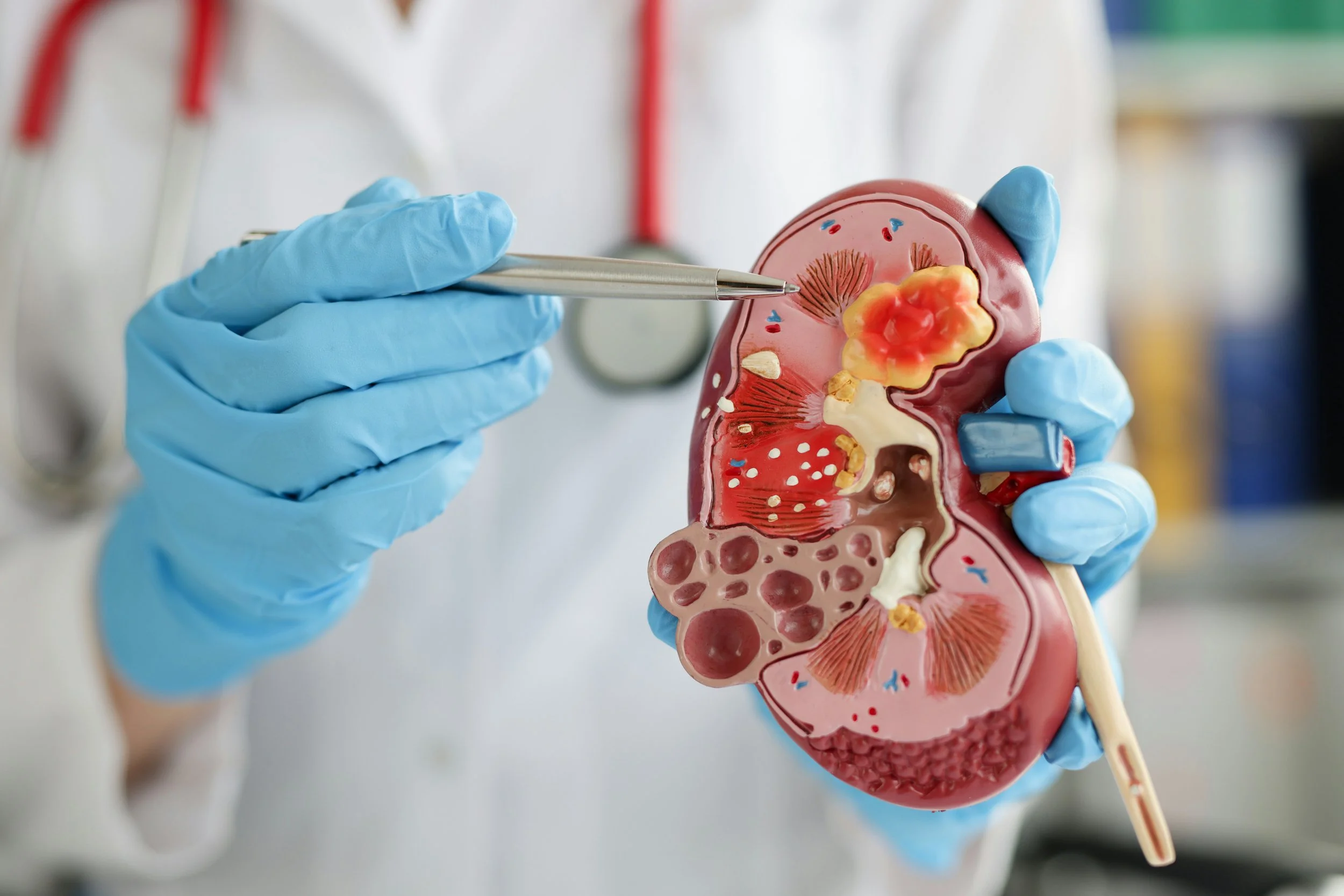 Lupus Nephritis | Impact on the Kidneys