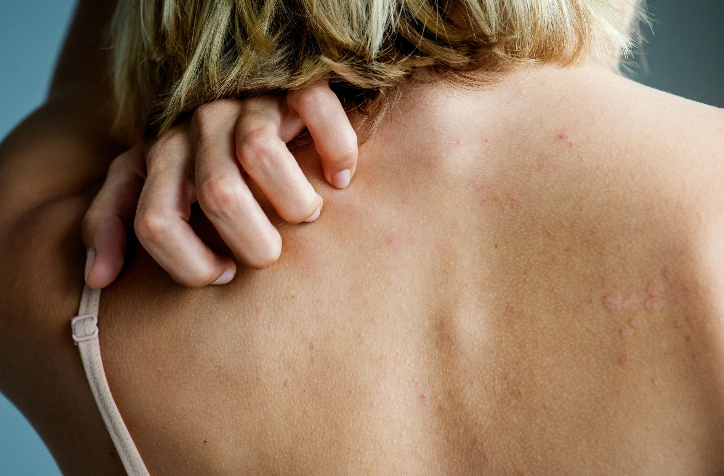 Skin Bacteria, Infections, and Lupus Flares