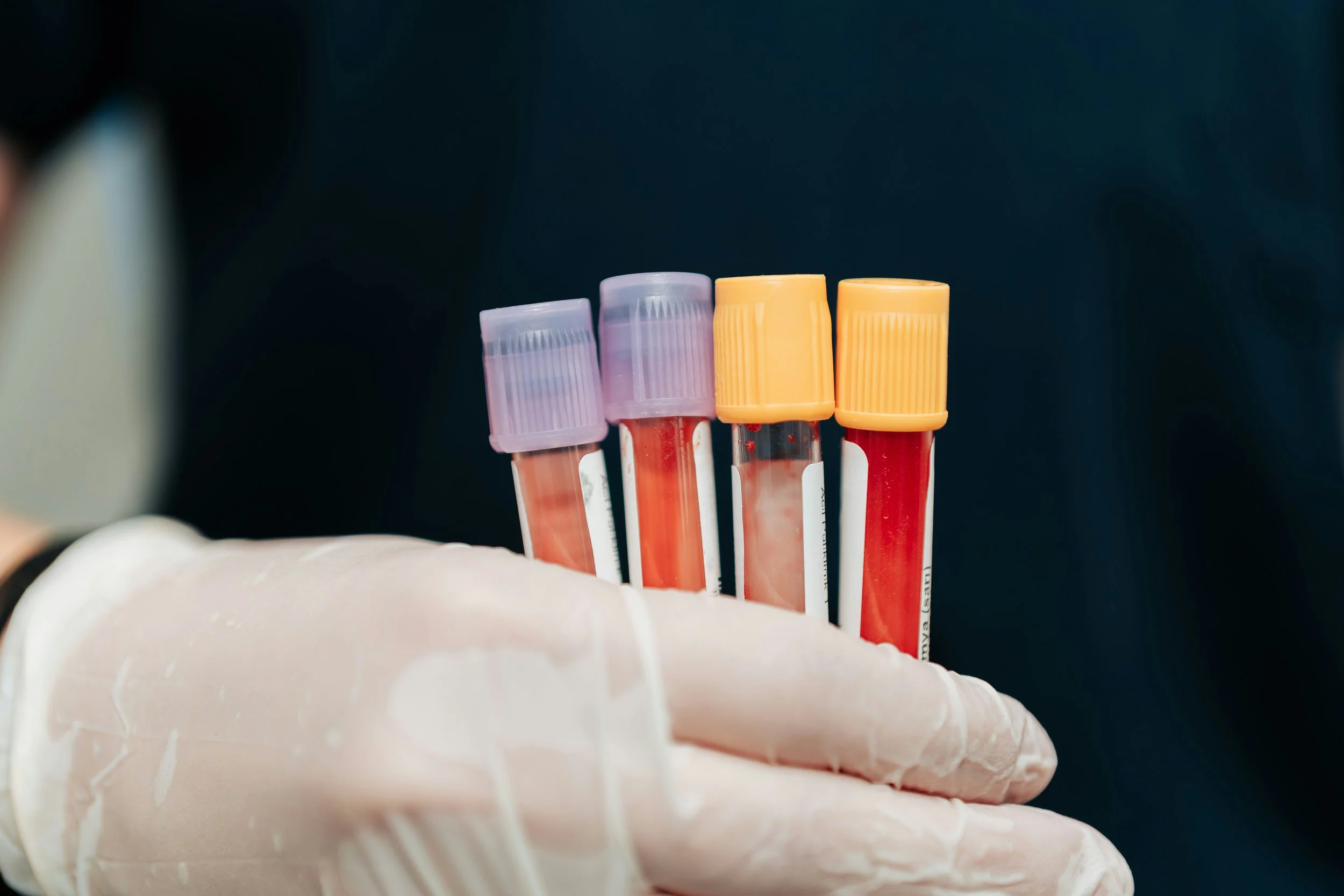 Blood Test Identifies Relatives with High Lupus Risk