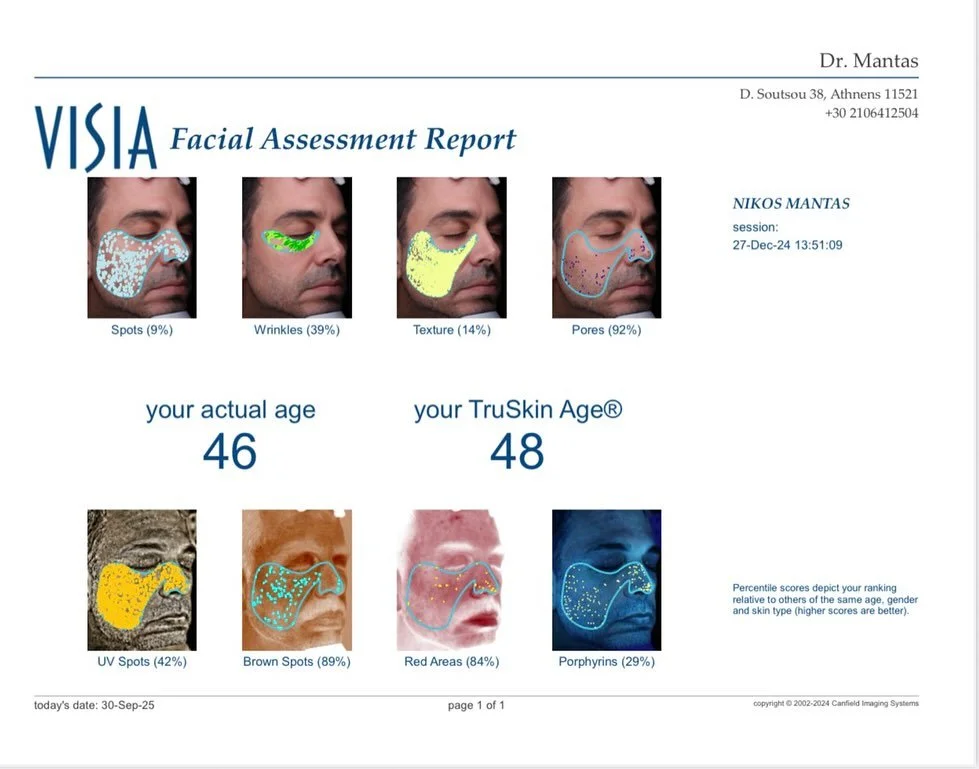 Skin analysis with Visia never lies !!
True skin age reversed by 10 years in just 10 months time !! The elixir of youth in our hands ! Dr.Mantas signature protocols are ready for you !
#drmantas👨&zwj;⚕️💉 #skin #skincare #aesthetics #aestheticdermat