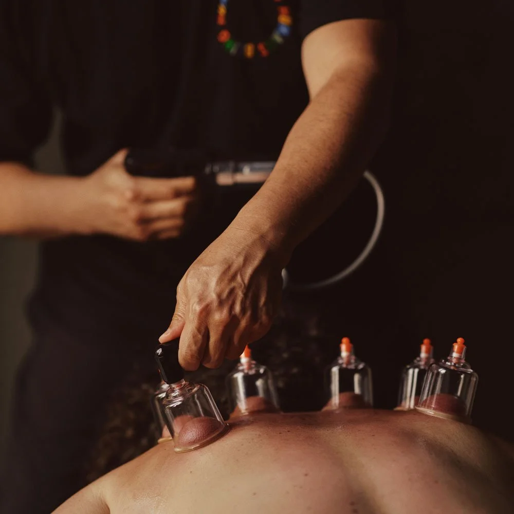 Five suction cups are placed on the back of someone lying face down, demonstrating a Cupping treatment.