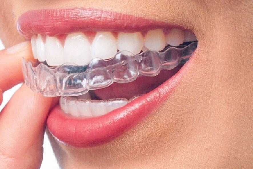 Invisalign.jpg