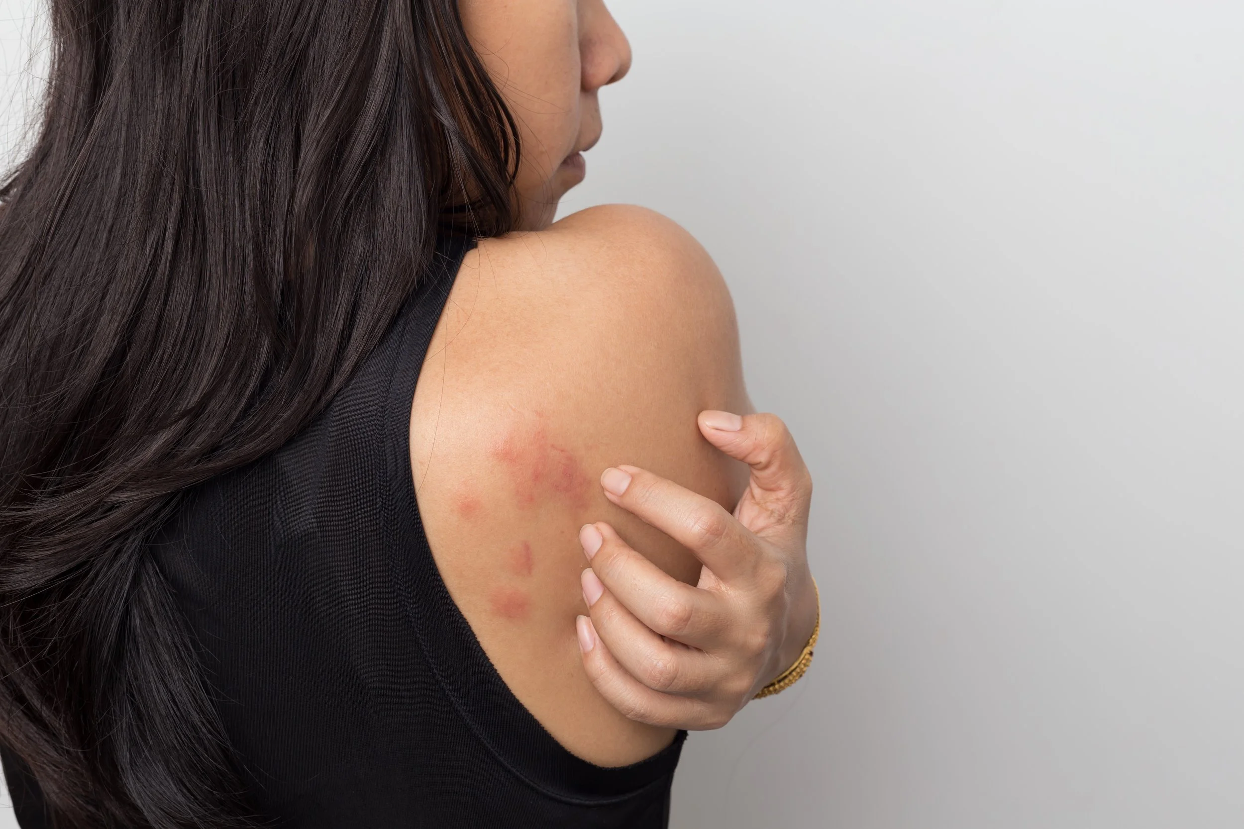 A woman with long dark hair touches her shoulder, which has red rash or spots.