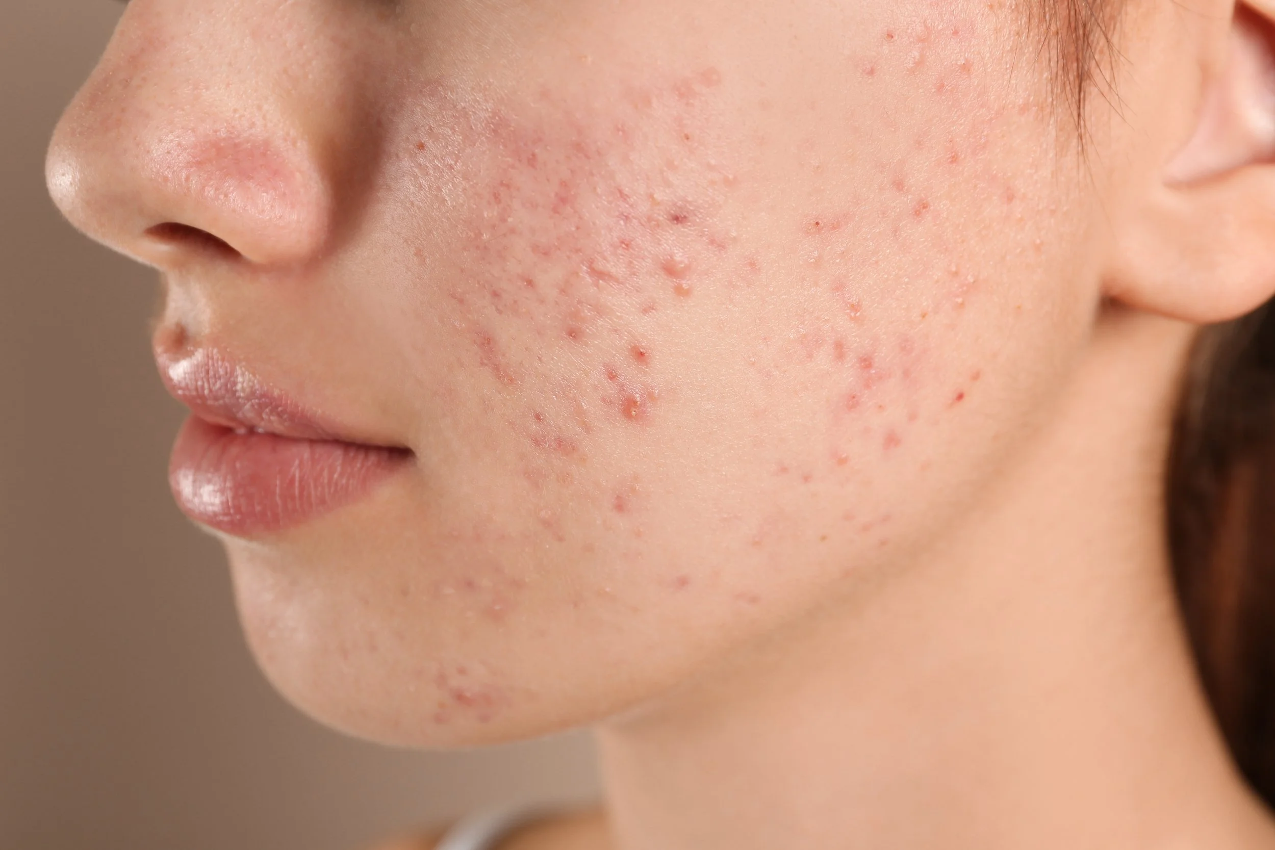 Close-up of a woman's cheek with acne and pimples.