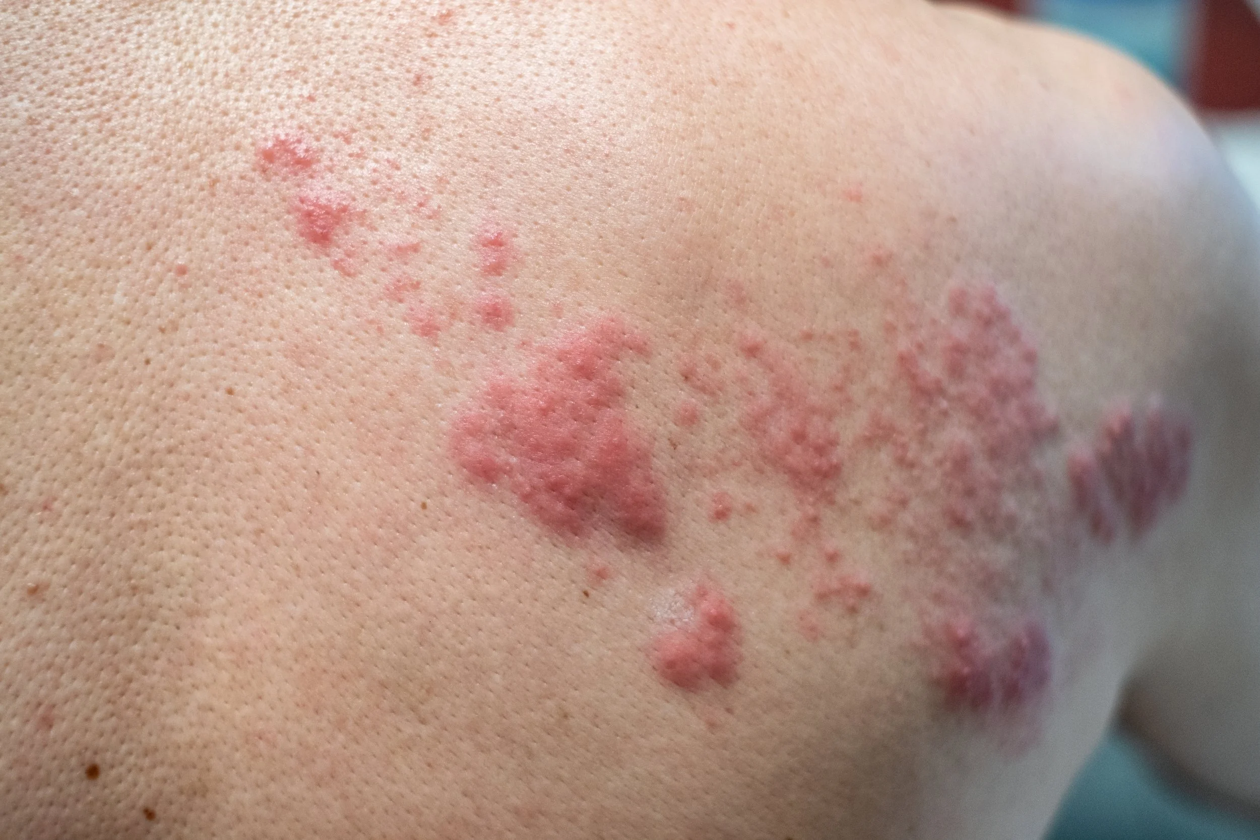 Close-up of skin with clustered red bumps or blisters, possibly a rash or skin condition.