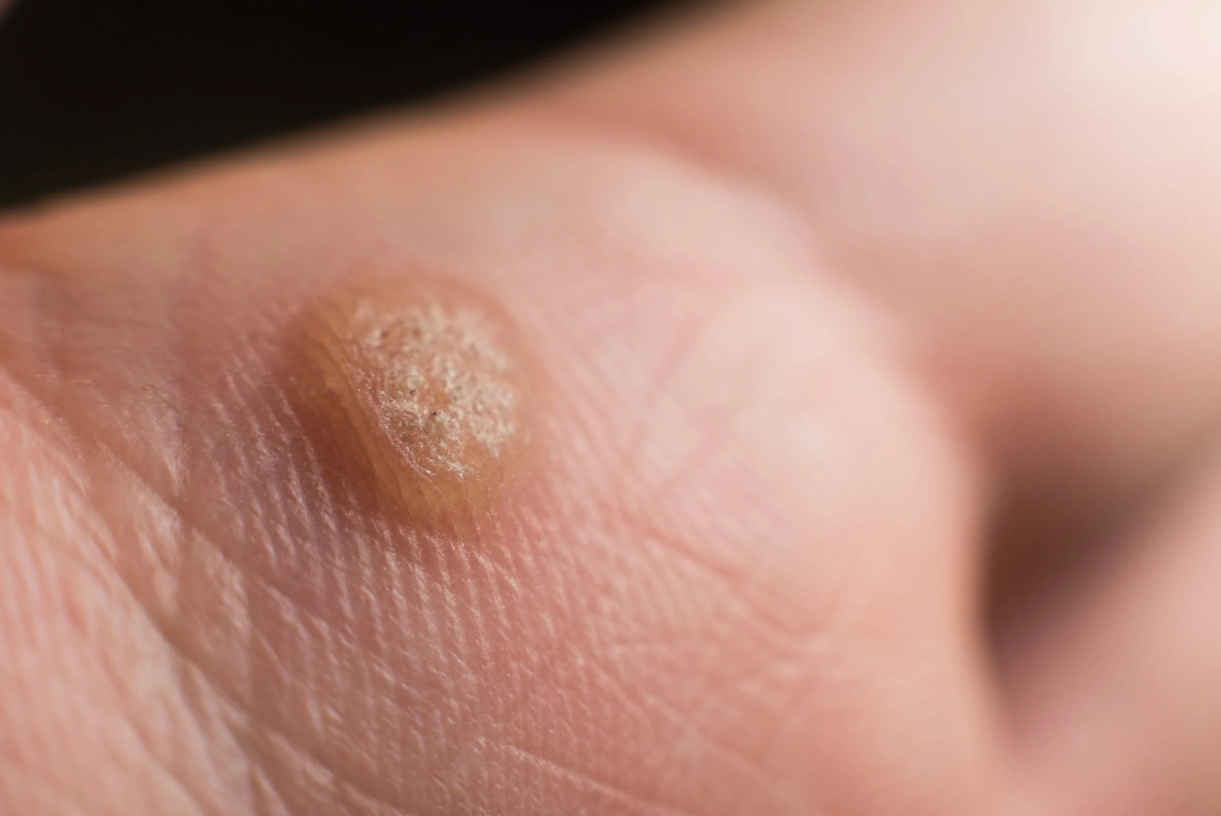 Close-up of a person's foot with a callus and dry, cracked skin.