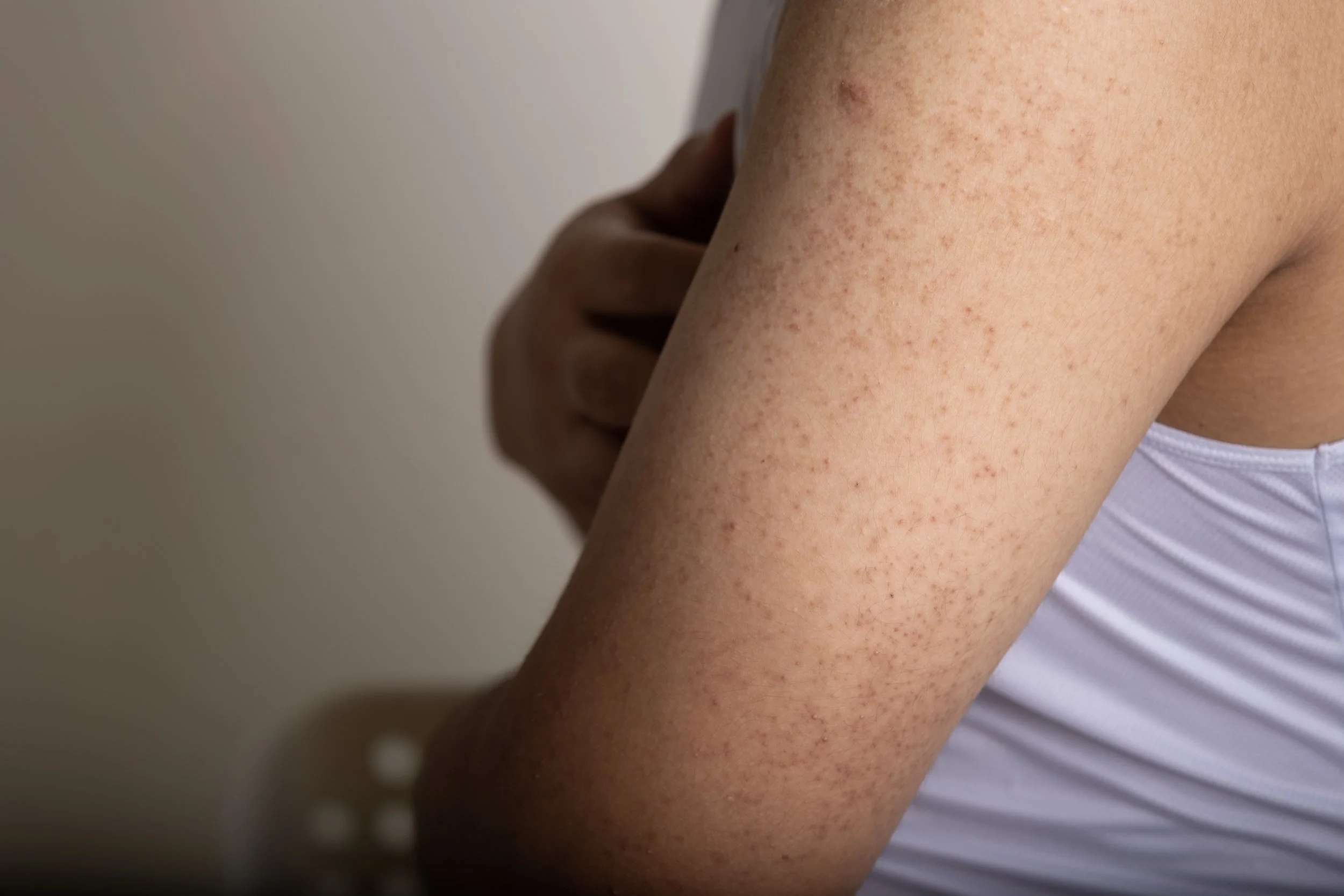 Close-up of a person's upper arm with red, inflamed, and irritated skin.