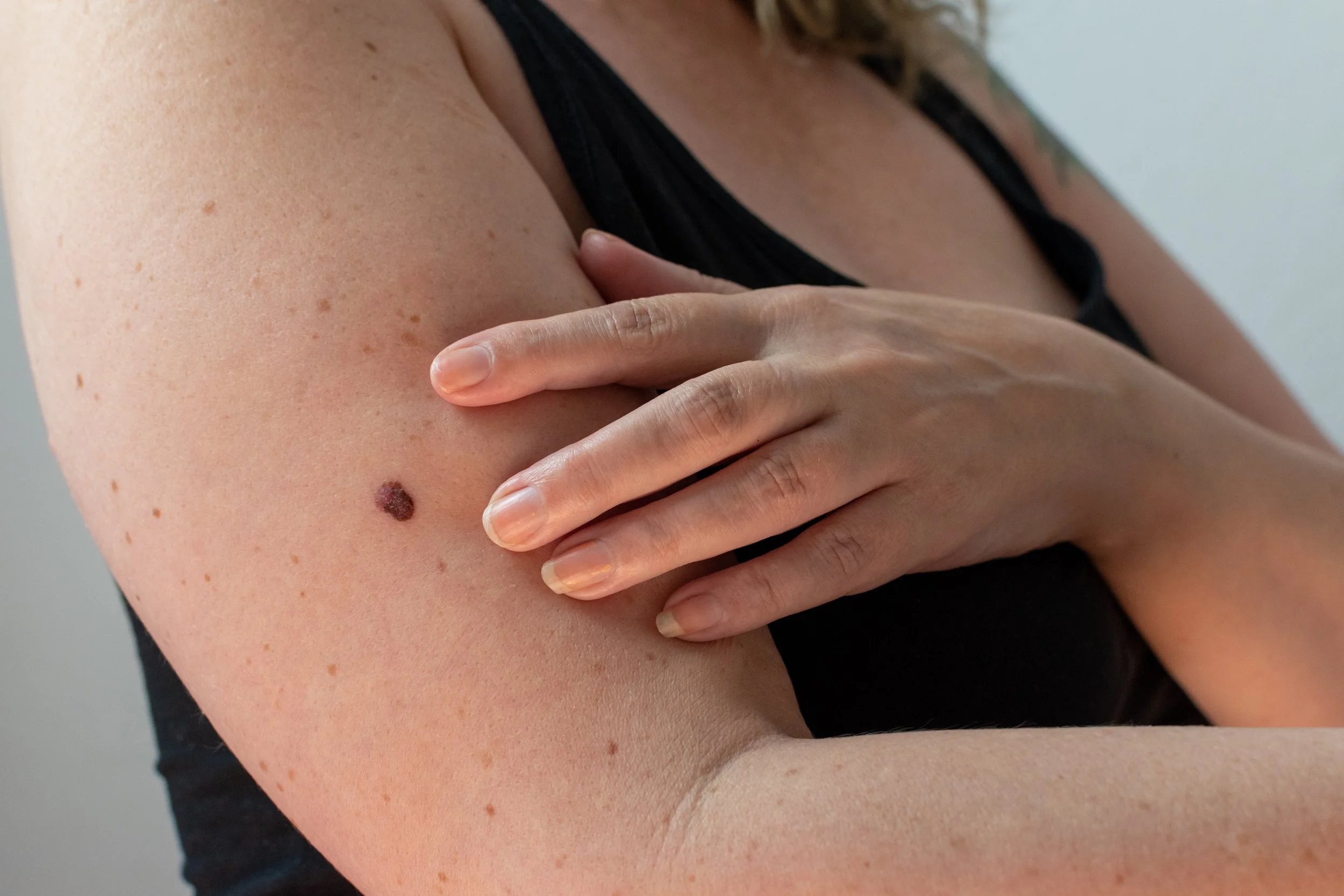 Close-up of a woman's upper arm with a mole and several small freckles, as she gently touches her arm with her hand.
