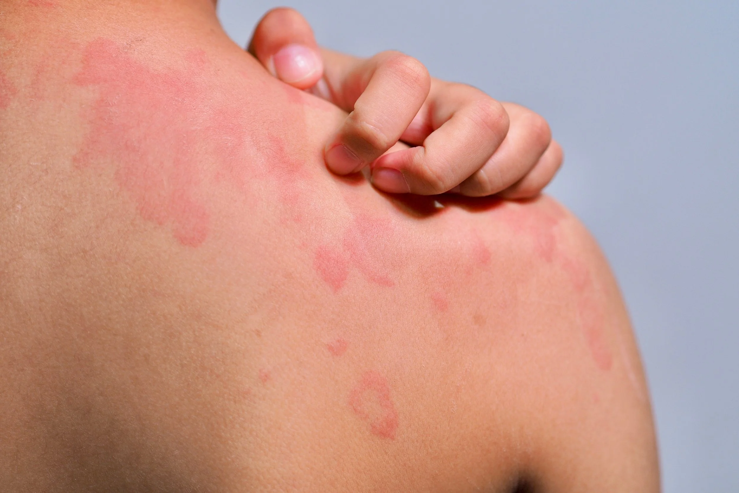 Close-up of a person's shoulder with red, itchy rash and a hand scratching the rash.