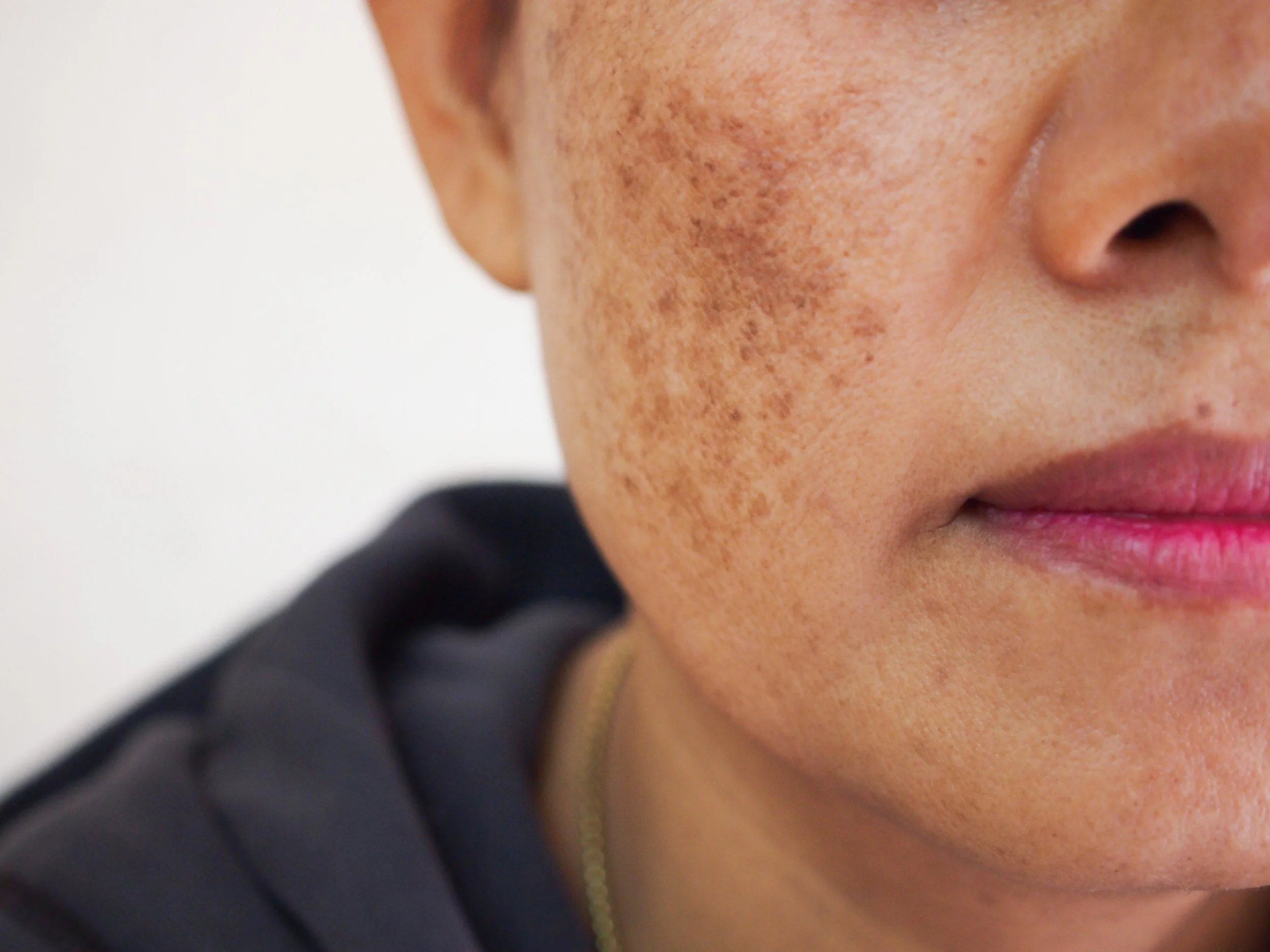 Close-up of a person's face showing hyperpigmentation on the cheek and around the nose.