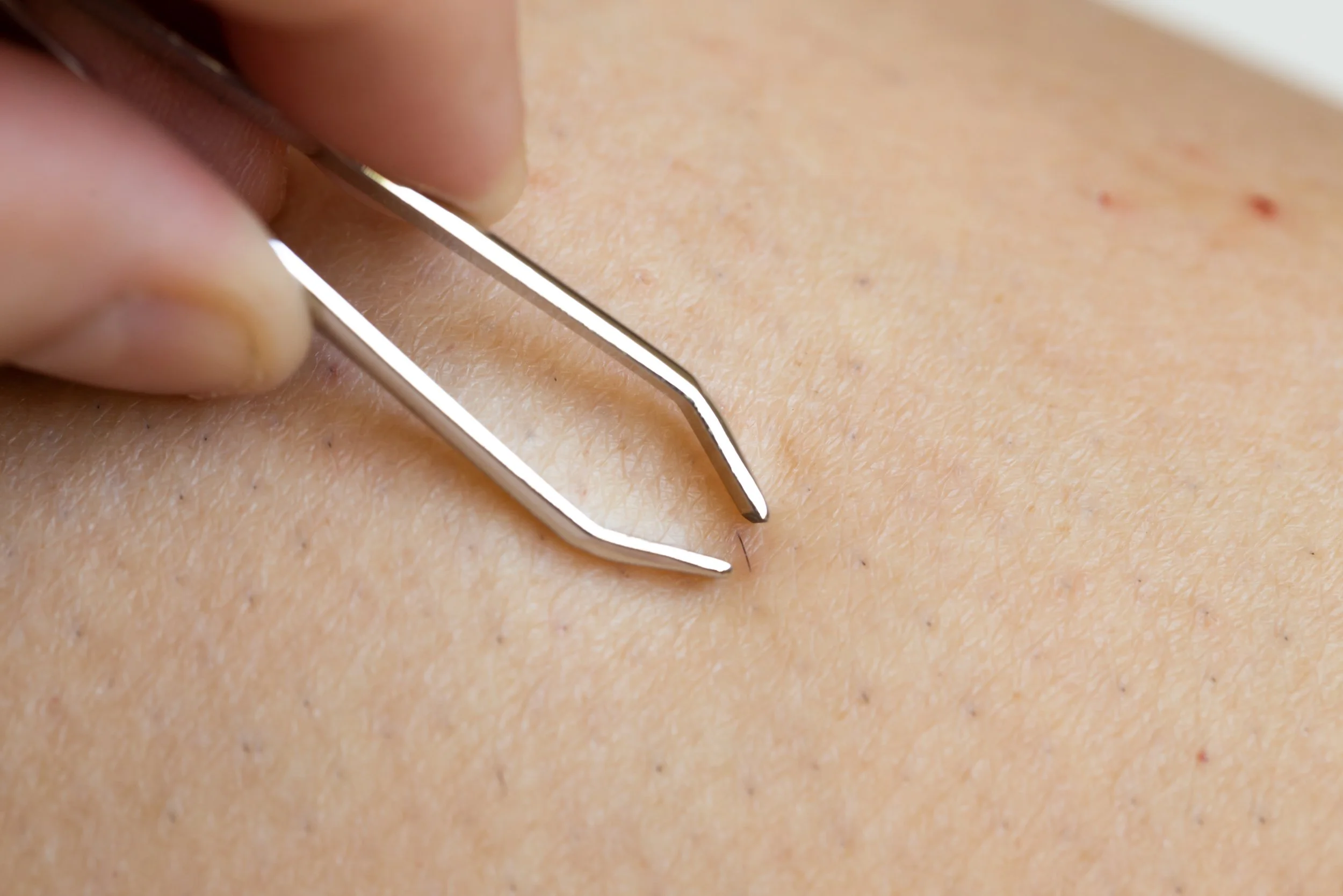 Close-up of a skin pore being examined with metal tweezers.