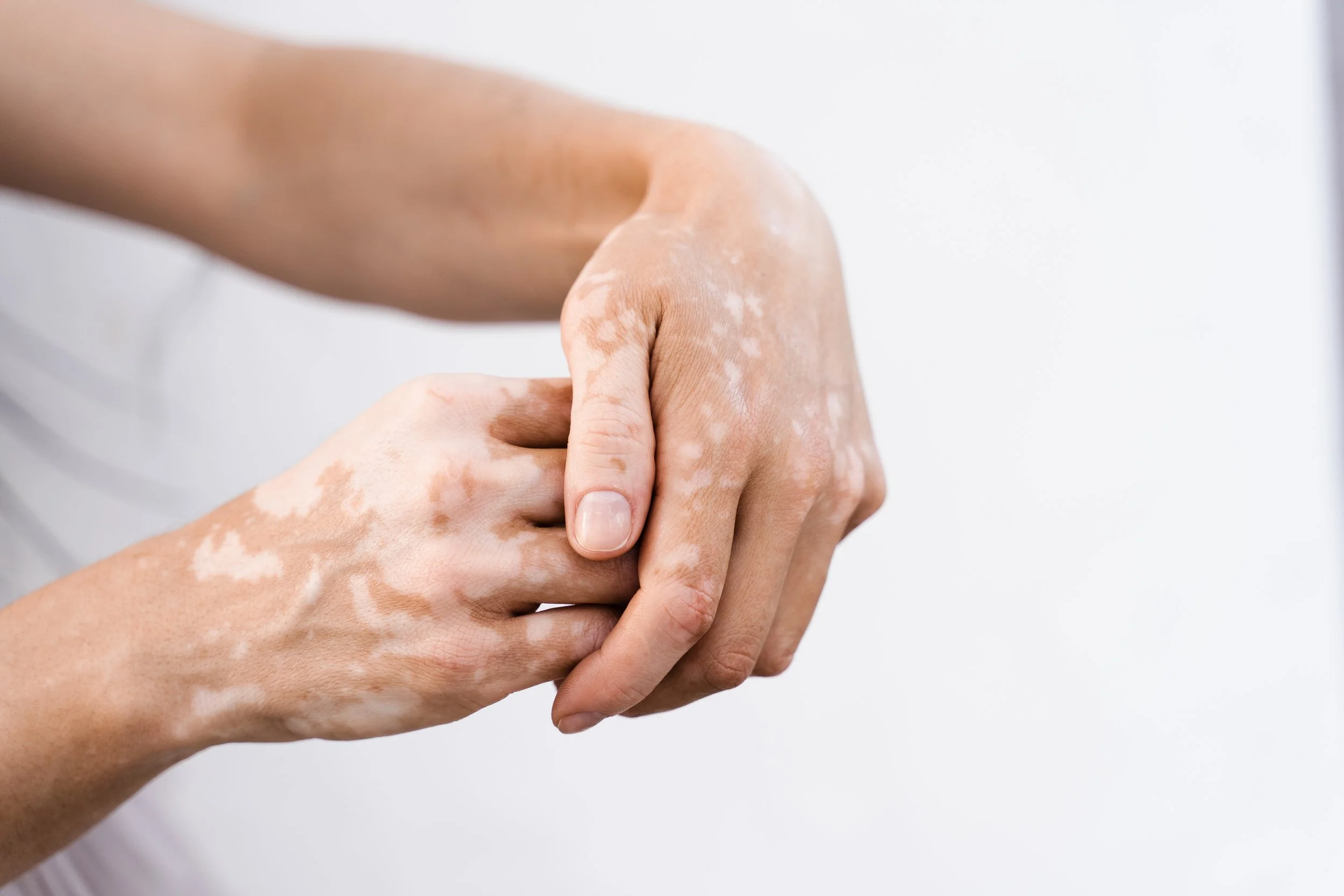 Two hands with white patches of skin condition holding each other against a white background.